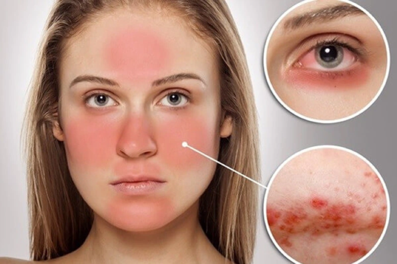 Hình ảnh một bệnh nhân bị lupus ban đỏ