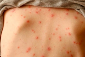 Bệnh thủy đậu mùa cao điểm: Cẩn trọng kẻo nhiễm trùng da