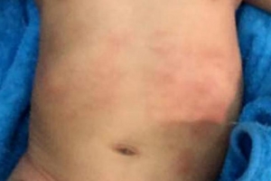 Mùa hè cần lưu ý bệnh nhiễm trùng huyết từ rôm sảy, mẩn ngứa của trẻ nhỏ