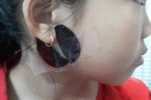 Cẩn trọng khi dùng cao dán trị quai bị