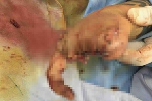 Lâm Đồng: Một phụ nữ bị nổ nát tay khi cầm lựu đạn thật tưởng giả