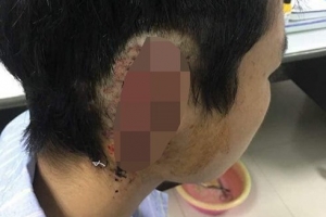 Nghệ An: Nam sinh cắn đứt tai bạn cùng trường nghi bị "ngáo" cỏ Mỹ