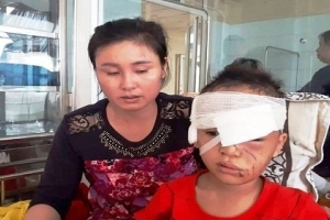 Thanh Hóa: Bé trai nhập viện khi bị chính chó nhà nuôi tấn công rách mặt
