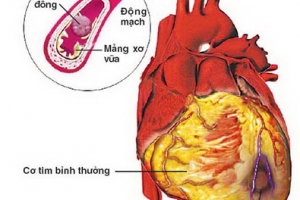Hút thuốc lá là nguyên nhân hàng đầu gây ra bệnh lý tim mạch