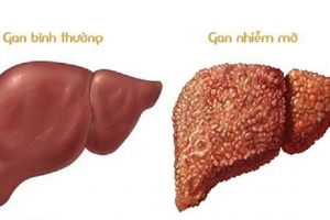 Nguy cơ bị gan nhiễm mỡ từ 6 loại thực phẩm