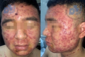 Trị mụn trứng cá bằng thuốc nam không nguồn gốc, nam thanh niên nhận cái kết đắng