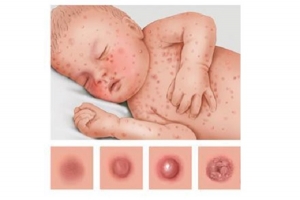 Xử lý các bệnh ngoài da do virus thường gặp như thế nào?