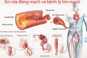 Máu nhiễm mỡ: Nguyên nhân, dấu hiệu và giải pháp hỗ trợ tốt cho bệnh
