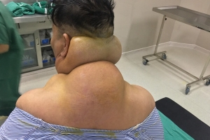 Người đàn ông ở Yên Bái bị biến dạng cơ thể sau nhiều năm nghiện rượu