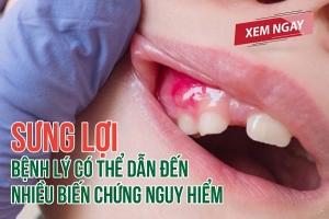 Sưng lợi – Bệnh lý có thể dẫn đến nhiều biến chứng nguy hiểm