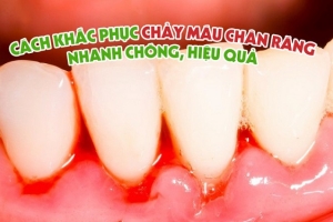 Cách khắc phục chảy máu chân răng nhanh chóng, hiệu quả nhất