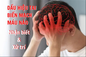 Dấu hiệu tai biến mạch máu não - Cách nhận biết và xử trí