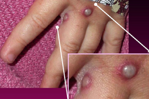 Sáu biện pháp phòng chống bệnh đậu mùa khỉ