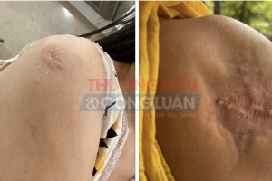 Hải Phòng: Tiêm thuốc chữa sẹo lồi người tiêu dùng bị tổn thương 23% cơ thể