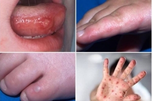 Khuyến cáo chủng virus EV71 gây bệnh tay chân miệng chuyển biến khó lường