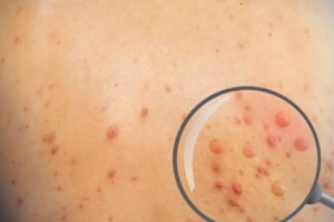 Tiền Giang phát hiện ca đậu mùa khỉ đầu tiên là một người làm vườn