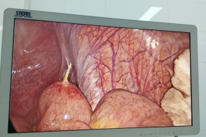 Bệnh viện Kiến An cấp cứu thành công bệnh nhân bị thủng ruột do nuốt phải tăm tre