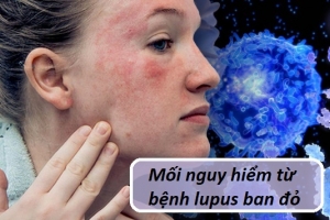 Mối nguy hiểm từ bệnh lupus ban đỏ và giải pháp từ Kim Miễn Khang
