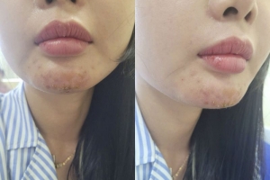 Tiêm filler không rõ nguồn gốc, một bệnh nhân bị nhiễm trùng phải nhập viện