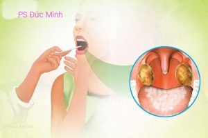 Vĩnh Phúc tăng cường công tác phòng, chống bệnh bạch hầu