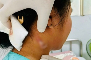 Đồng Nai: “Vi khuẩn ăn thịt người” xuất hiện ở một bệnh nhân 14 tuổi