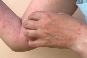 Tiền Giang chủ động tăng cường phòng, chống bệnh đậu mùa khỉ