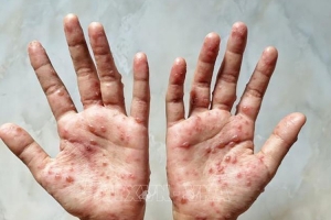 Hà Nội: Tăng cường phòng chống bệnh đậu mùa khỉ