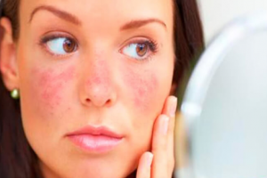Triệu chứng chẩn đoán lupus ban đỏ và cách đẩy lùi bệnh từ Kim Miễn Khang