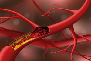Biến chứng nguy hiểm của rối loạn lipid máu và giải pháp ngăn ngừa từ LIPIDcleanz