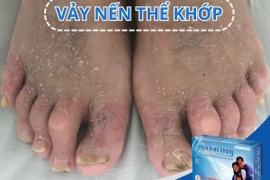 Vảy nến thể khớp không còn nguy hiểm nếu có Kim Miễn Khang