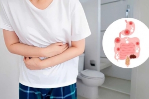 Nhận diện triệu chứng điển hình của hội chứng ruột kích thích