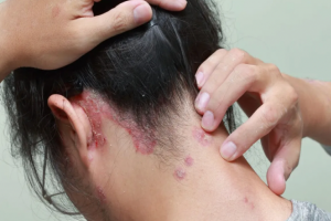 Thuốc nào chữa vảy nến da đầu tốt? Dùng Kim Miễn Khang có được không?