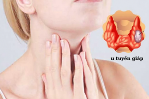 Đi khám phát hiện mắc u tuyến giáp TIRADS 4 thì phải làm sao?