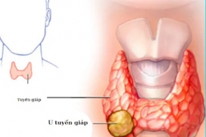 Nhân tuyến giáp tirads 3 và cách điều trị bệnh hiệu quả, tránh phải mổ
