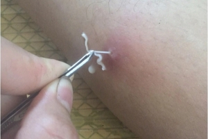 Giám sát một ca bệnh bị nhiễm giun rồng tại thành phố Hòa Bình