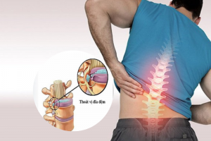 4 giai đoạn thoát vị đĩa đệm và giải pháp cải thiện hiệu quả từ Cốt Thoái Vương