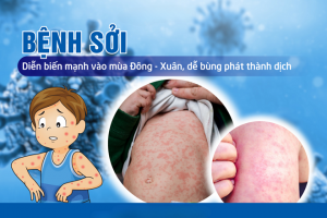 Trẻ em mắc sởi: Dinh dưỡng đúng cách giúp tăng sức đề kháng, đẩy lùi bệnh tật