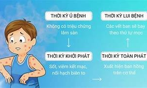 Số lượng ca mắc sởi tại Thái Bình có chiều hướng gia tăng