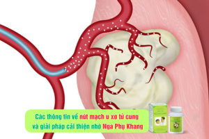 Thông tin về nút mạch u xơ tử cung và giải pháp cải thiện từ Nga Phụ Khang