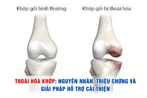 Thoái hóa khớp: Nguyên nhân, triệu chứng và giải pháp hỗ trợ cải thiện