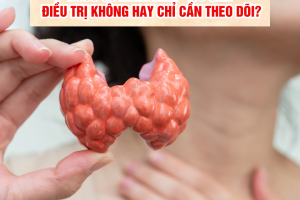 Bướu cổ lành tính – Có cần điều trị không hay chỉ cần theo dõi?
