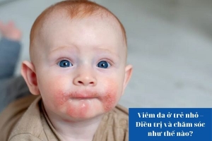Viêm da ở trẻ nhỏ – Điều trị và chăm sóc như thế nào?