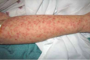 WHO cảnh báo virus Chikungunya có thể gây sốt cao, đau khớp