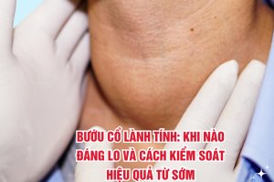Bướu cổ lành tính: Khi nào đáng lo và cách kiểm soát hiệu quả từ sớm