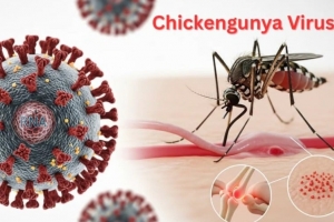 Bệnh Chikungunya dễ bị nhầm lẫn với bệnh khác