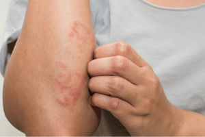 Dị ứng sau bơi lội: Đừng xem nhẹ làn da nhạy cảm