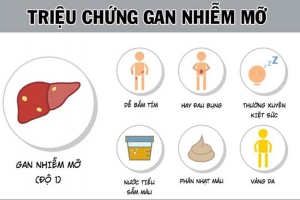 8 nhóm người có nguy cơ cao mắc bệnh gan nhiễm mỡ: Những dấu hiệu cảnh báo không thể bỏ qua
