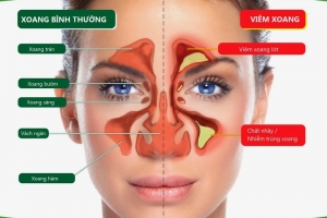 Viêm xoang bướm do nấm: Bệnh lý thầm lặng dễ gây mù lòa, cảnh báo khi đau đầu kéo dài