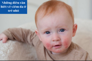 Những điều cần biết về viêm da ở trẻ nhỏ