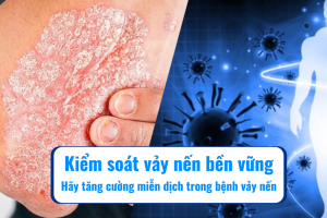 Kiểm soát vảy nến bền vững – Hãy tăng cường miễn dịch
